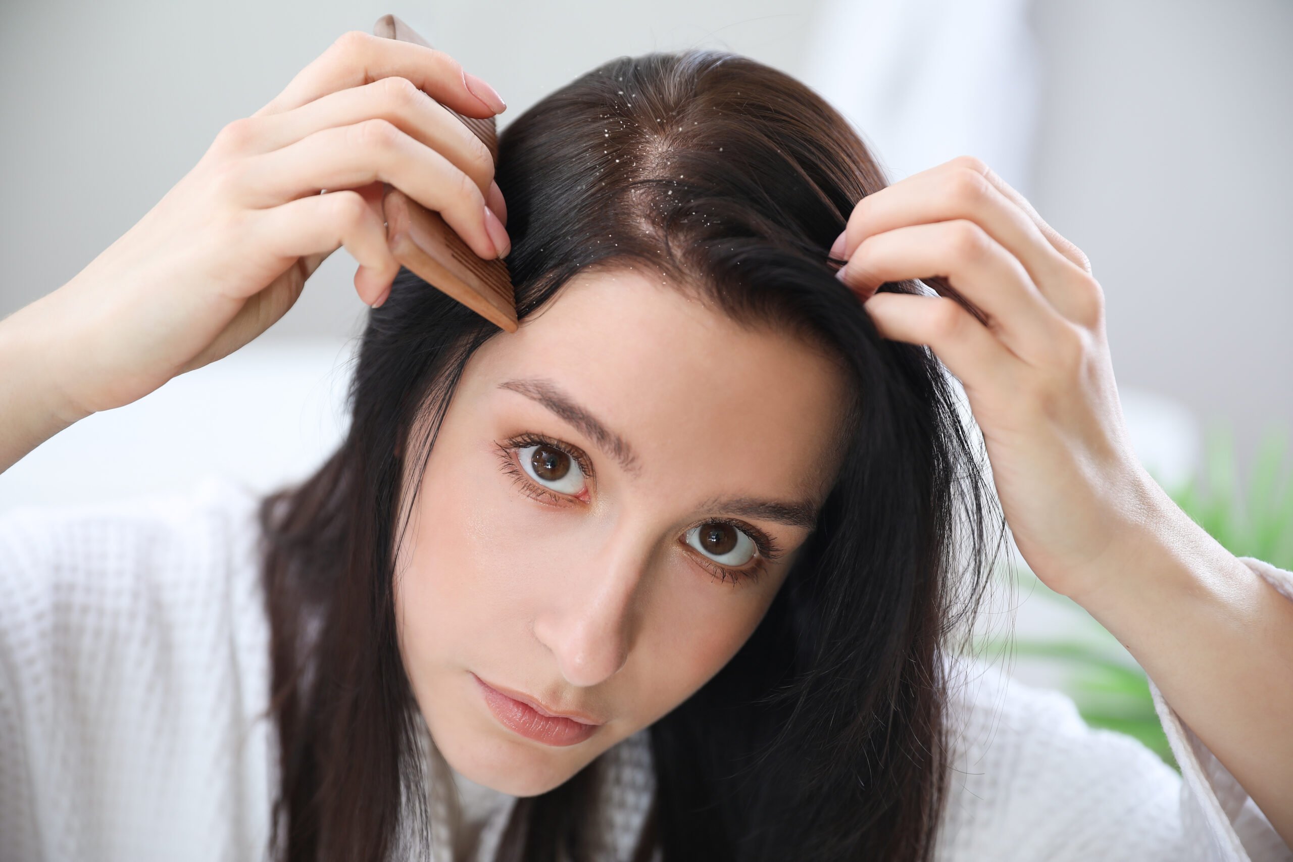 Young woman with problem of dandruff at home